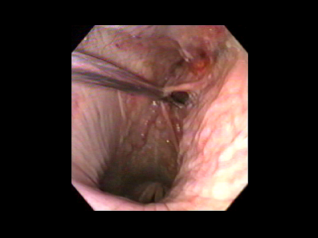 endoscopic view of the nasopharynx with a catheter