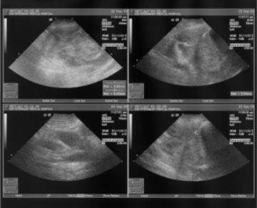 Thoracic ultrasound