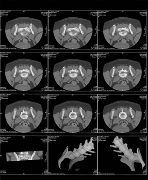 CT of Lumosacral Region