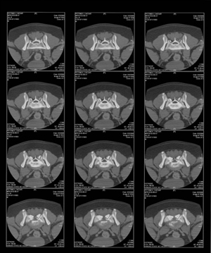 CT of Lumosacral Region