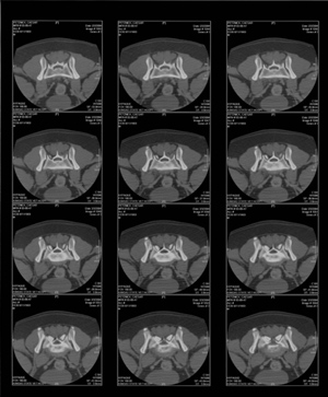 CT of Lumosacral Region