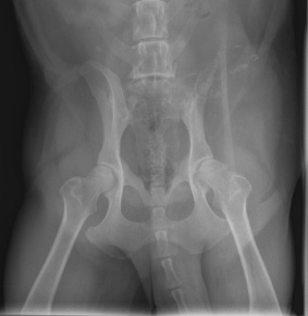 Osteosarcoma of the ilial wing