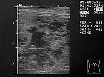 Ultrasonographic image of the liver