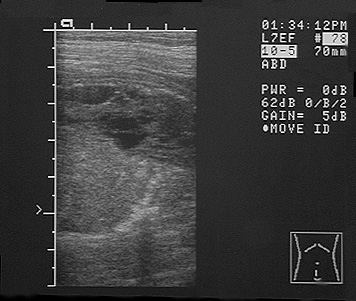 Ultrasound image of sublumbar lymphnodes