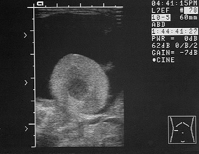 Ultrasonographic image of the right kidney