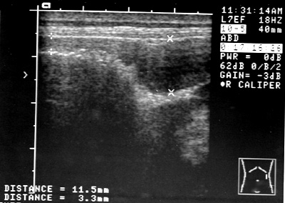 Ultrasound image of colon