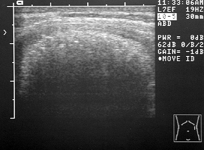 Ultrasound image of colon