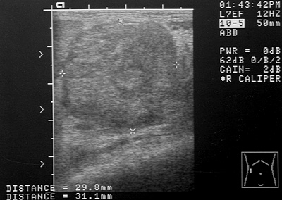 Ultrasound image of an abdominal mass
