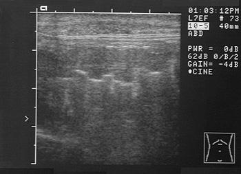 Ultrasonographic image of the intestine