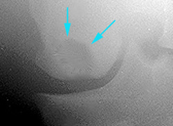 Radiograph showing a Subchondral bone cyst (arrows) at the medial condyle of the right femur