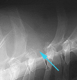 Radiograph of the Right lateral view