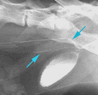 Radiograph of the Right Lateral Oblique View