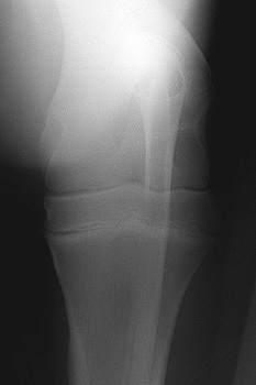 Radiograph of the Craniocaudal View - Right Elbow 