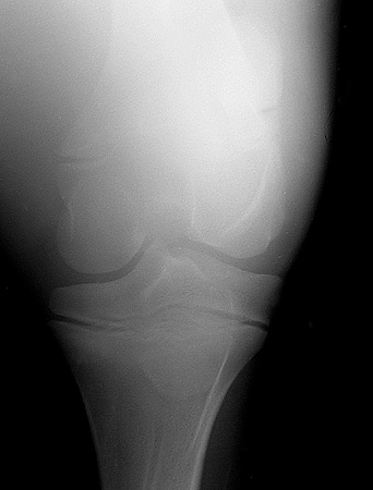 Radiograph of the Craniocaudal View of Left Stifle